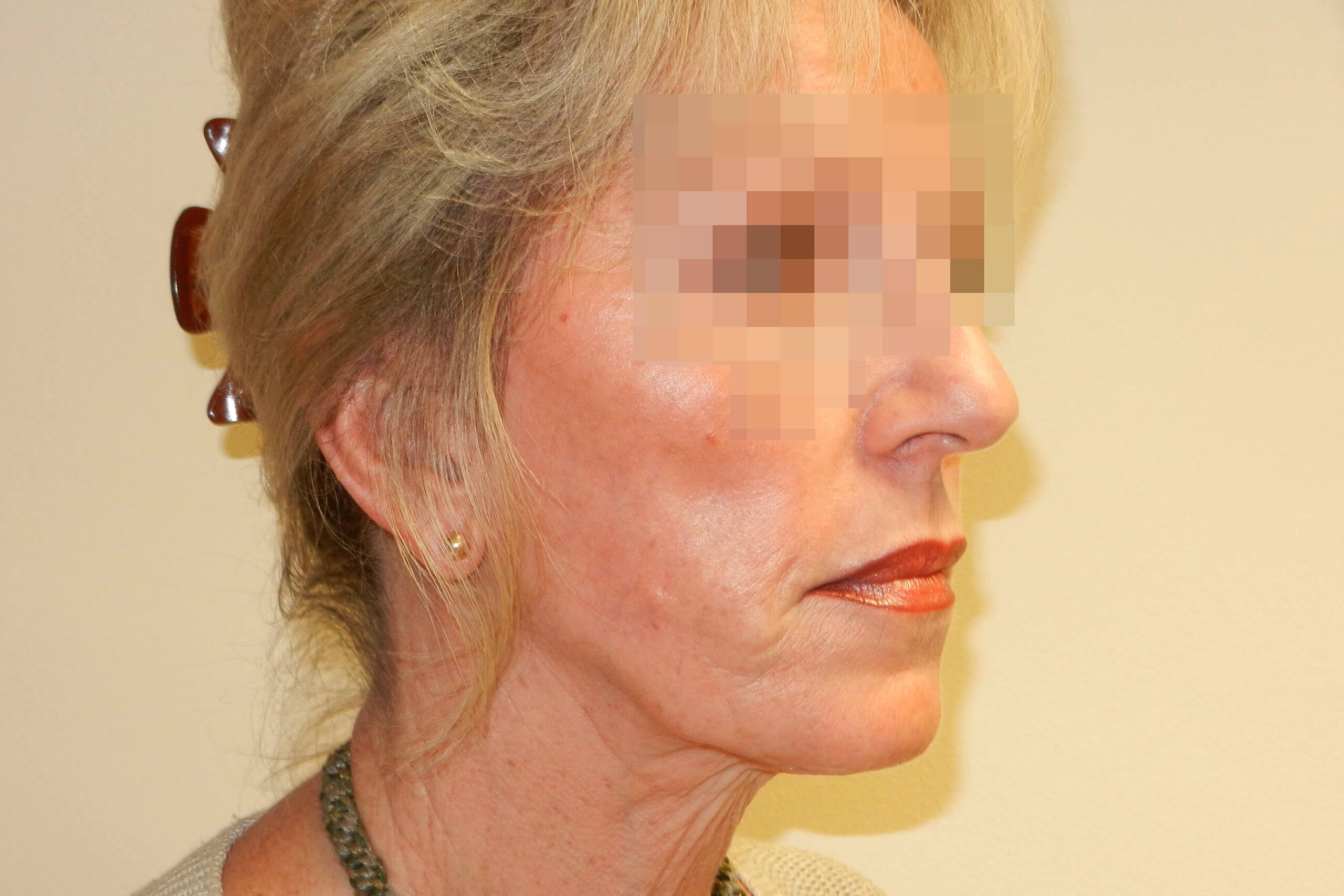 2012 Oct Facelift side post surgery 4 months result David Oliver Exeter