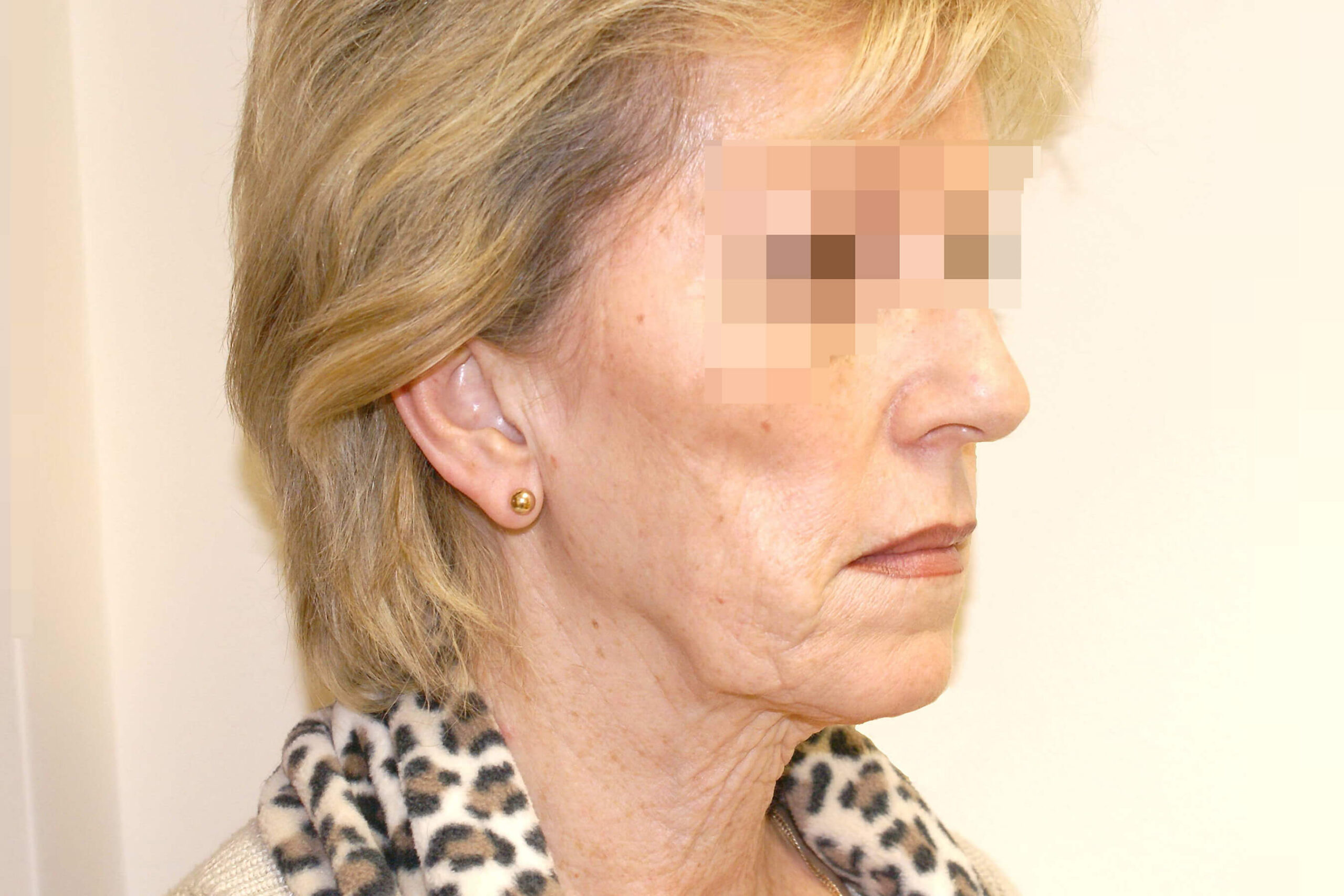 2012 Oct Facelift side pre surgery David Oliver Exeter