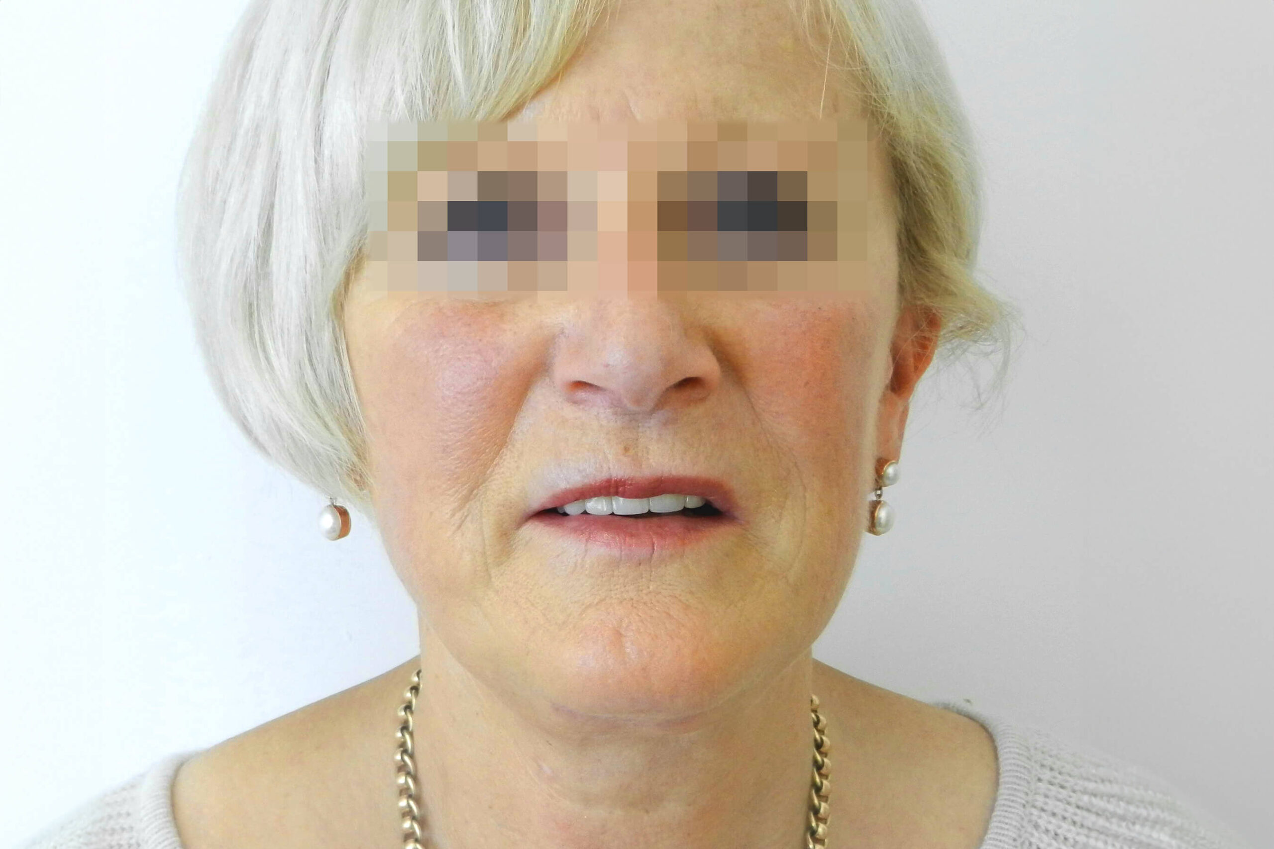 2013 Sept Facelift front post surgery result David Oliver Exeter