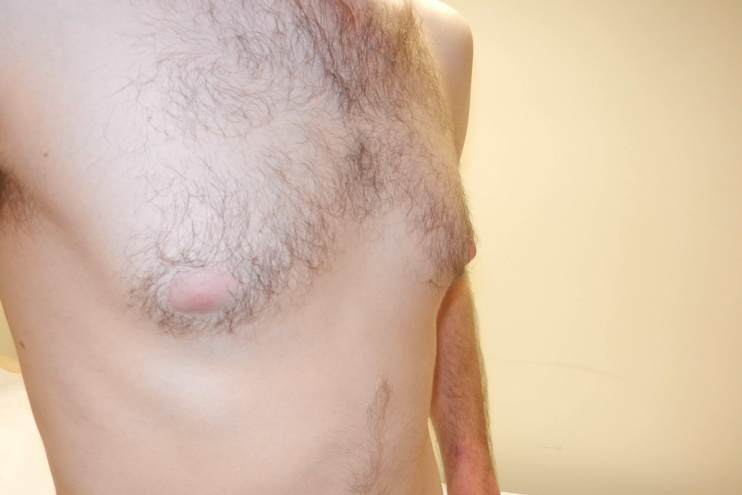 2015 Jul - Gynaecomastia Male Breast Reduction pre surgery side result David Oliver Devon