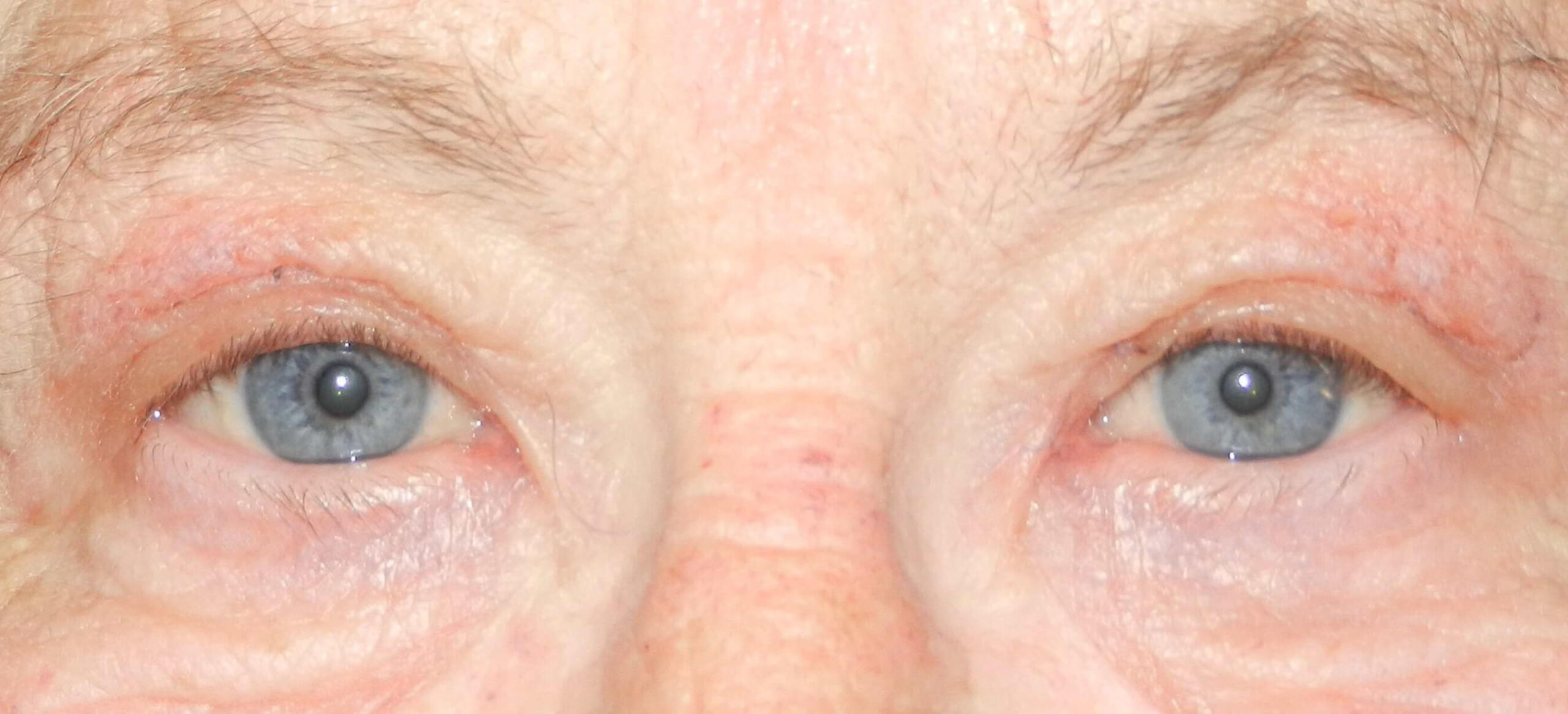 2015 Oct - Blepharoplasty post surgery front result David Oliver Exeter