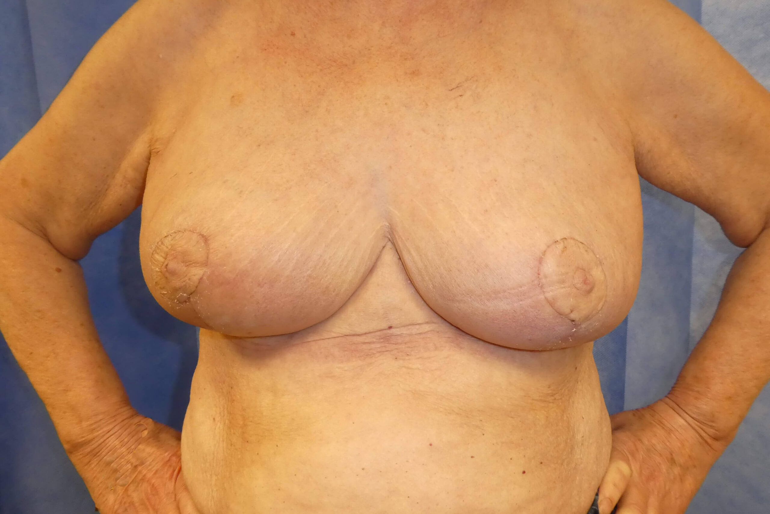 2017 DEC - Breast reduction post surgery front result David Oliver Exeter
