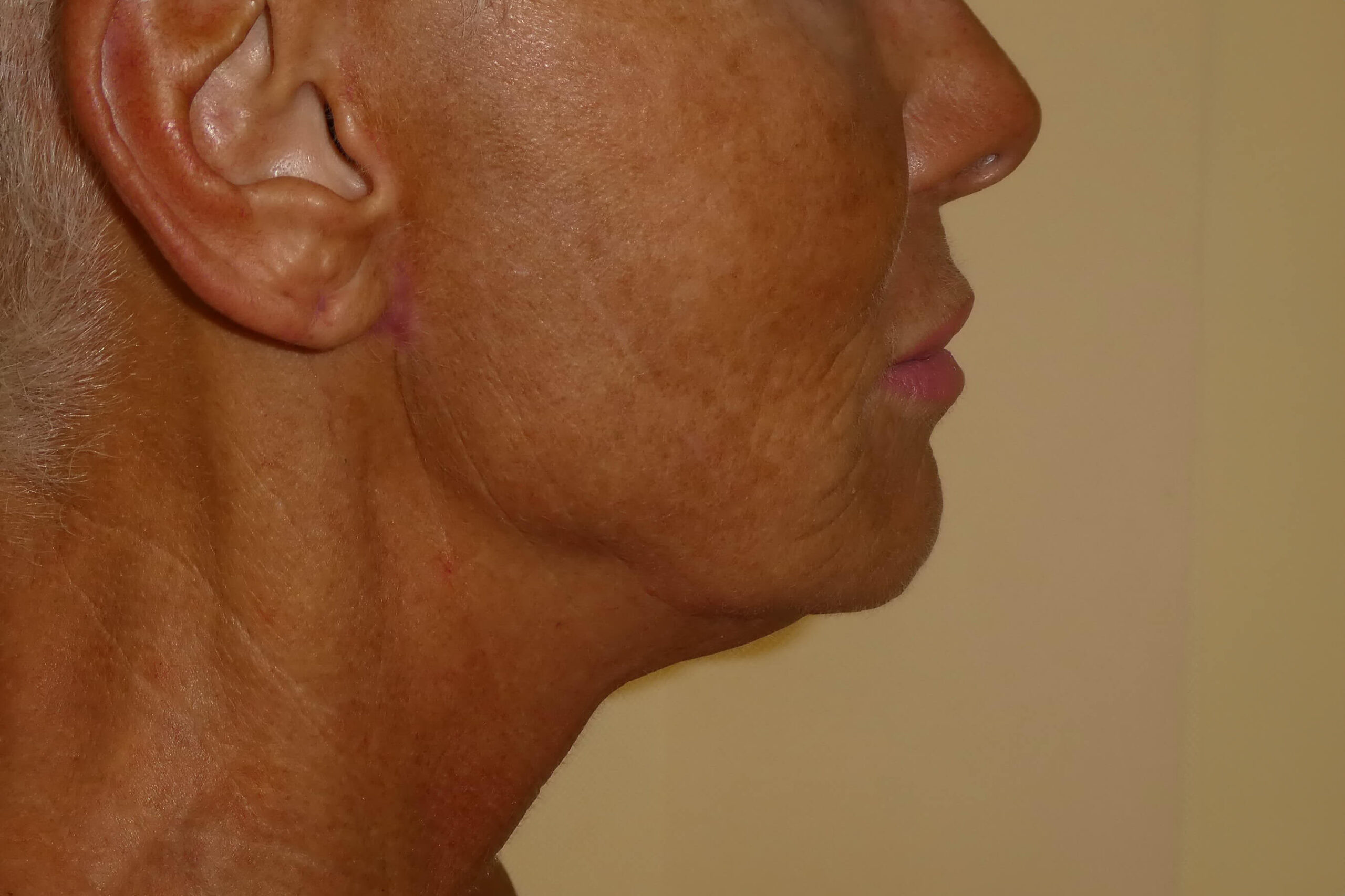 2018 Sept Facelift side 2 post surgery 2 months David Oliver Exeter
