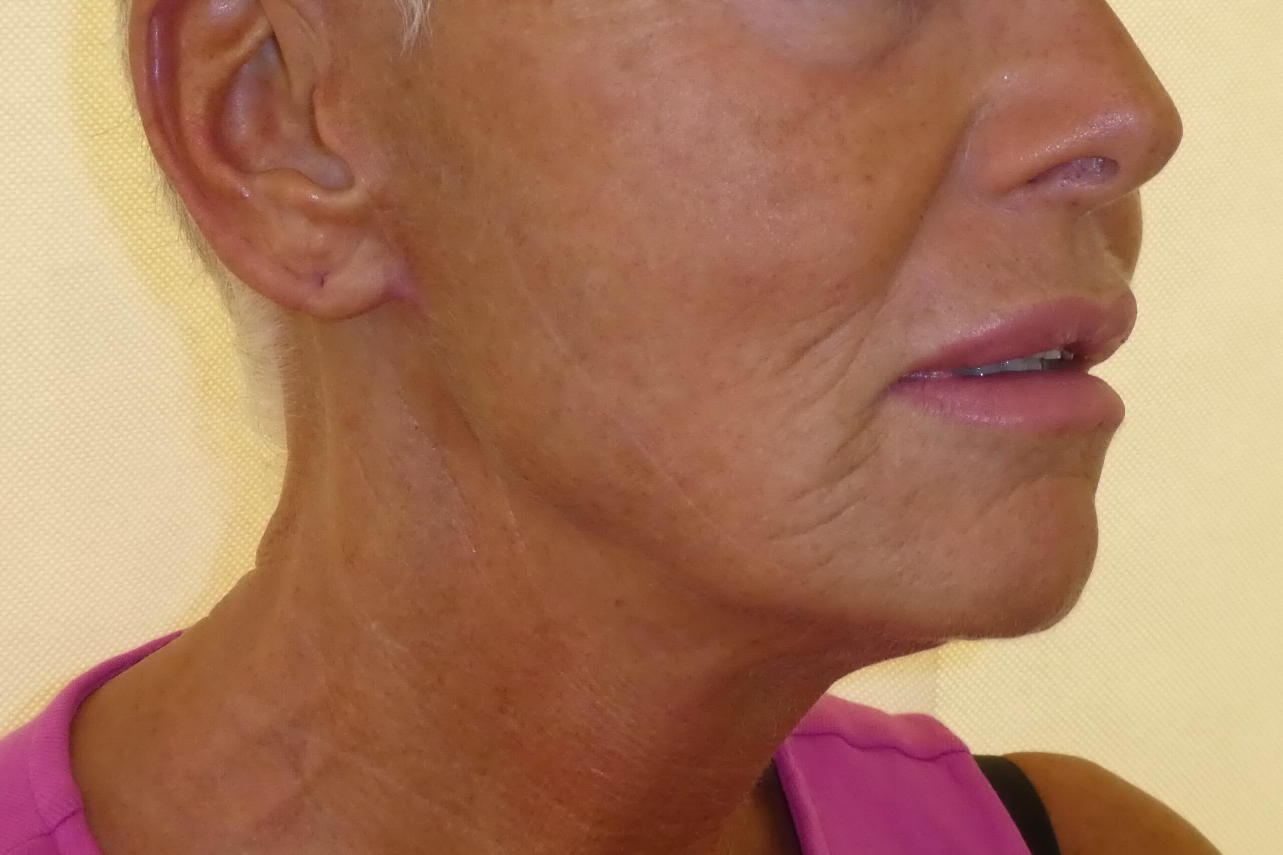2018 Sept Facelift side post surgery 2 months David Oliver Exeter