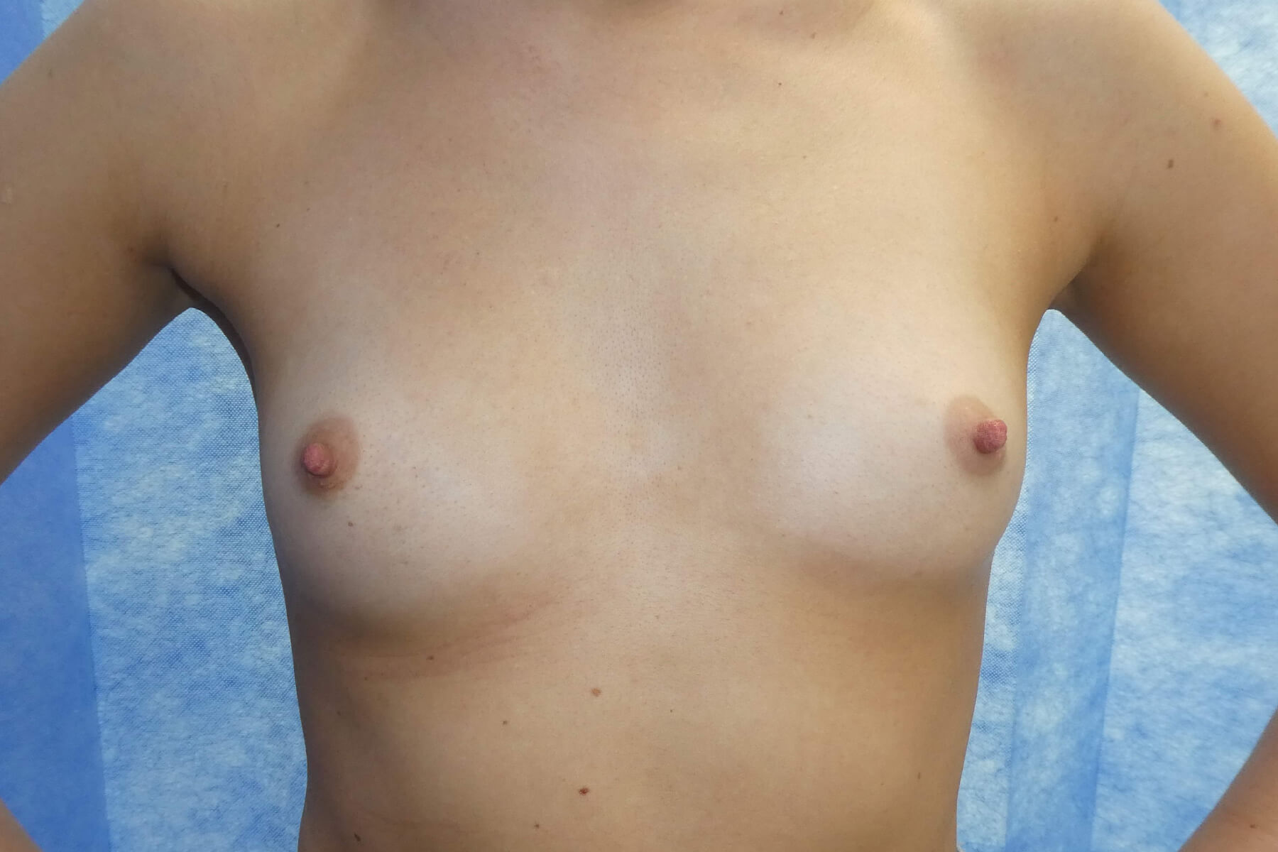 2022 Dec - Bi lateral Breast Augmentation front view pre surgery result David Oliver Exeter