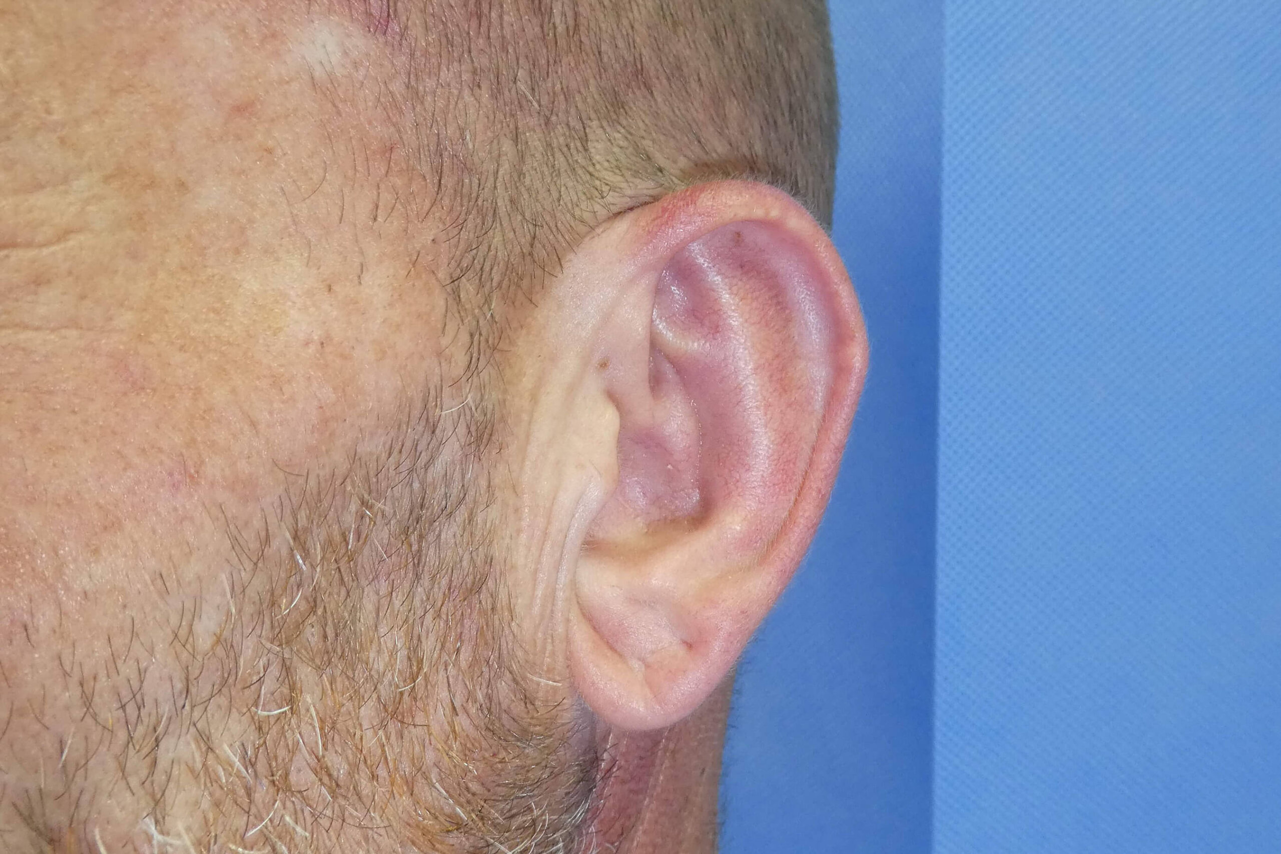 2022 September - Otoplasty post surgery side left result David Oliver Devon